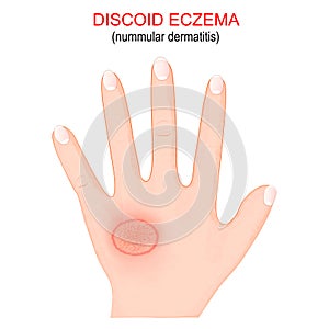 Nummular dermatitis. Discoid eczema photo